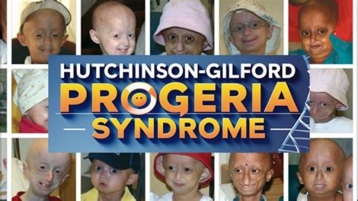 Baby Eline Leonie Progeria Disease