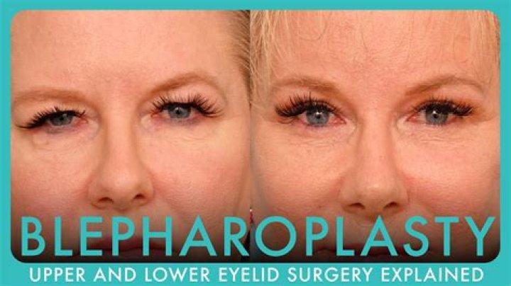 Uncover The Secrets Of Curt Blepharoplasty: Discoveries And Insights